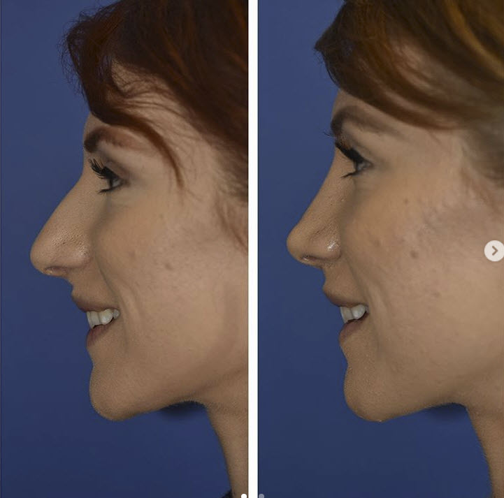 seattle rhinoplasty